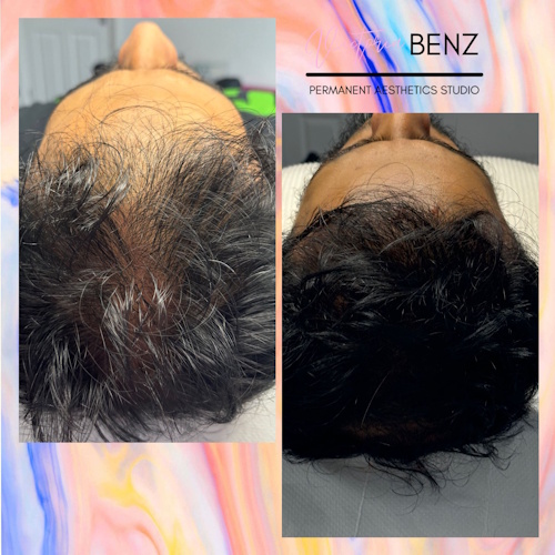 PRP for hair loss3